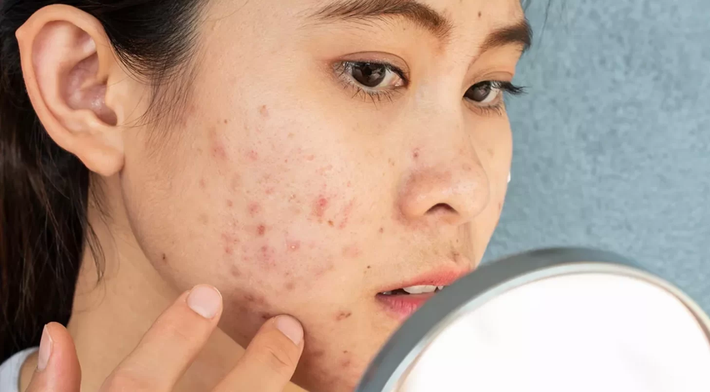 hudproblem kvinde med akne ser sig selv i spejlet asiatisk