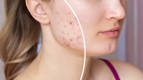 natural acne treatment - woman with acne